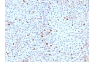 IHC testing of FFPE human bladder carcinoma with Topoisomerase II alpha antibody (clone TOP2A/1361). (Topoisomerase II alpha antibody  (AA 1352-1493))