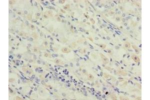 Immunohistochemistry of paraffin-embedded human gastric cancer using ABIN7142334 at dilution of 1:100