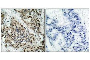 Immunohistochemical analysis of paraffin-embedded human breast carcinoma tissue using FKHR (Phospho-Ser256) Antibody (left) or the same antibody preincubated with blocking peptide (right). (FOXO1 antibody  (pSer256))