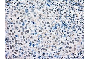 Immunohistochemical staining of paraffin-embedded Adenocarcinoma of ovary tissue using anti-MAPK1mouse monoclonal antibody. (ERK2 antibody)