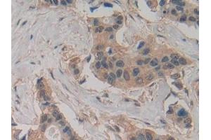 Detection of Slit2 in Human Breast cancer Tissue using Polyclonal Antibody to Slit Homolog 2 (Slit2) (SLIT2 antibody  (AA 1416-1528))