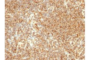 Formalin-fixed, paraffin-embedded human Lymphoma stained with CD20 Mouse Monoclonal Antibody (L26). (CD20 antibody)