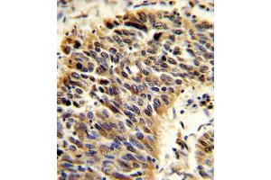 Formalin-fixed and paraffin-embedded human lung carcinoma reacted with VTN Antibody (N-term), which was peroxidase-conjugated to the secondary antibody, followed by DAB staining. (Vitronectin antibody  (N-Term))