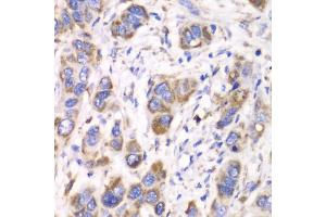 Immunohistochemistry of paraffin-embedded human esophageal cancer using ALDH2 antibody (ABIN5970568) at dilution of 1/100 (40x lens). (ALDH2 antibody)