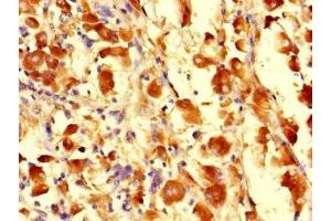 Immunohistochemistry of paraffin-embedded human melanoma using ABIN7163108 at dilution of 1:100 (CDS1 antibody  (AA 6-85))