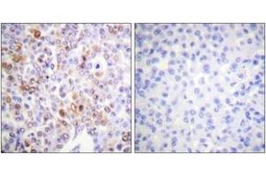 Immunohistochemistry analysis of paraffin-embedded human breast carcinoma tissue, using Histone H4 (Acetyl-Lys16) Antibody.