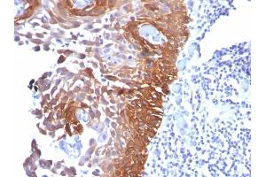 Formalin-fixed, paraffin-embedded human Cervical Carcinoma stained with CK17 Mouse Monoclonal Antibody (E3).