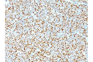 Formalin-fixed, paraffin-embedded human Mantle Cell Lymphoma stained with Cyclin D1 Mouse Monoclonal Antibody (DCS-6). (Cyclin D1 antibody)