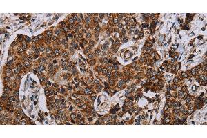 Immunohistochemistry of paraffin-embedded Human liver cancer using NDUFA4 Polyclonal Antibody at dilution of 1:40 (NDUFA4 antibody)