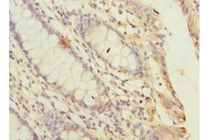 Immunohistochemistry of paraffin-embedded human colon cancer using ABIN7169258 at dilution of 1:100