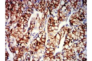 Immunohistochemical analysis of paraffin-embedded renal cancer tissues using CD203C mouse mAb with DAB staining.