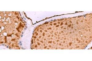 Immunohistochemistry of paraffin-embedded Human thyroid cancer tissue using ASTE1 Polyclonal Antibody at dilution of 1:50(x200) (ASTE1 antibody)