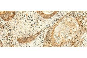 Immunohistochemistry of paraffin-embedded Human esophagus cancer tissue using ARL4D Polyclonal Antibody at dilution of 1:50(x200) (ARL4D antibody)