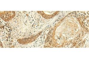 Immunohistochemistry of paraffin-embedded Human esophagus cancer tissue using ARL4D Polyclonal Antibody at dilution of 1:50(x200) (ARL4D antibody)
