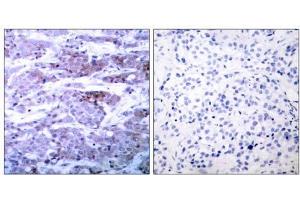 Immunohistochemical analysis of paraffin- embedded human breast carcinoma tissue using BAD (Ab-112) antibody (E021062). (BAD antibody)