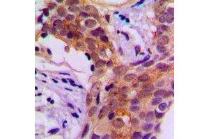 Immunohistochemical analysis of Beta-actin staining in human prostate cancer formalin fixed paraffin embedded tissue section.
