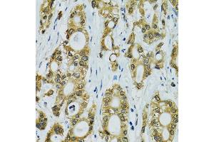 Immunohistochemistry of paraffin-embedded human rectal cancer using RPS7 antibody.