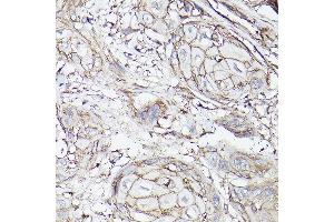 Immunohistochemistry of paraffin-embedded human esophageal cancer using MCT4/SLC16 Rabbit pAb (ABIN6129472, ABIN6147859, ABIN6147860 and ABIN6214836) at dilution of 1:100 (40x lens). (SLC16A3 antibody  (AA 371-465))