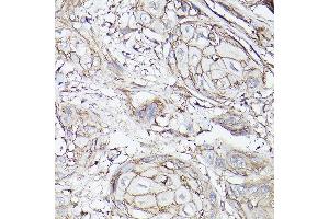 Immunohistochemistry of paraffin-embedded human esophageal cancer using MCT4/SLC16 Rabbit pAb (ABIN6129472, ABIN6147859, ABIN6147860 and ABIN6214836) at dilution of 1:100 (40x lens). (SLC16A3 antibody  (AA 371-465))