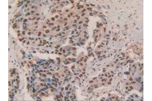 IHC-P analysis of Human Breast Cancer Tissue, with DAB staining. (HDGF antibody  (AA 10-240))