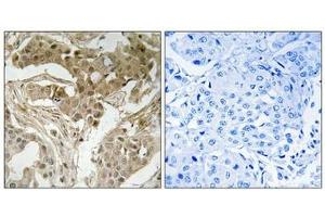 Immunohistochemical analysis of paraffin-embedded human breast carcinoma tissue using FOS (Phospho-Thr232) antibody (left)or the same antibody preincubated with blocking peptide (right). (c-FOS antibody  (pThr232))