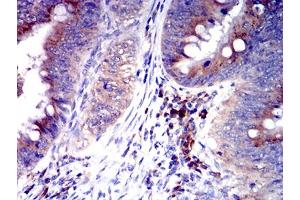 Immunohistochemical analysis of paraffin-embedded rectum cancer tissues using CD327 mouse mAb with DAB staining. (SIGLEC6 antibody  (AA 27-347))