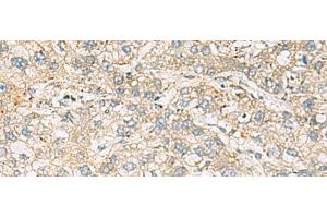 Immunohistochemistry of paraffin-embedded Human liver cancer tissue using LRRC28 Polyclonal Antibody at dilution of 1:60(x200) (LRRC28 antibody)