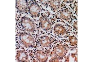 Immunohistochemical analysis of PIR121 staining in human colon cancer formalin fixed paraffin embedded tissue section. (CYFIP2 antibody  (C-Term))