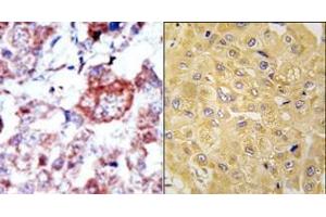 (LEFT)Formalin-fixed and paraffin-embedded human cancer tissue reacted with the primary antibody, which was peroxidase-conjugated to the secondary antibody, followed by AEC staining. (ILK antibody  (N-Term))