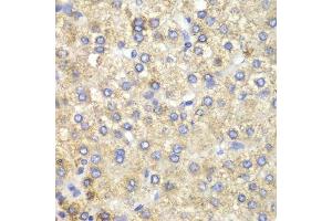 Immunohistochemistry of paraffin-embedded human liver cancer using HADH antibody.