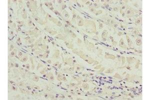 Immunohistochemistry of paraffin-embedded human gastric cancer using ABIN7155798 at dilution of 1:100 (MEOX1 antibody  (AA 1-254))