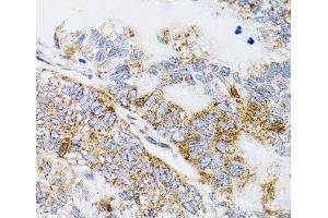 Immunohistochemistry of paraffin-embedded Human gastric cancer using PDYN Polyclonal Antibody at dilution of 1:100 (40x lens). (PDYN antibody)