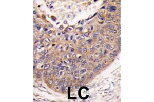 Formalin-fixed and paraffin-embedded human lung carcinoma tissue reacted with FXN polyclonal antibody  , which was peroxidase-conjugated to the secondary antibody, followed by DAB staining. (Frataxin antibody  (C-Term))