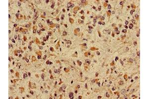 Immunohistochemistry of paraffin-embedded human glioma using ABIN7149048 at dilution of 1:100 (CRIPT antibody  (AA 1-101))