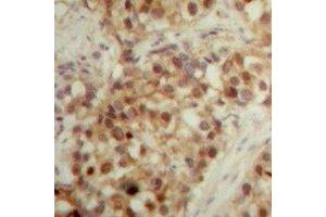Immunohistochemical analysis of LONP2 staining in human breast cancer formalin fixed paraffin embedded tissue section. (LONP2 antibody  (C-Term))
