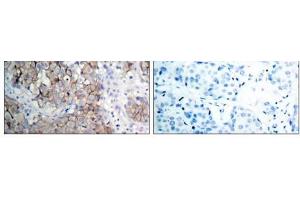 Immunohistochemical analysis of paraffin- embedded human breast carcinoma tissue using IGF-1R (phospho-Tyr1161) antibody (E011087). (IGF1R antibody  (pTyr1161))
