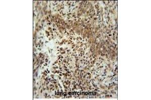ZN Antibody (Center) (ABIN654509 and ABIN2844236) immunohistochemistry analysis in formalin fixed and paraffin embedded human lung carcinoma followed by peroxidase conjugation of the secondary antibody and DAB staining. (ZNF667 antibody  (AA 303-331))