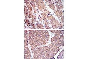 Immunohistochemical analysis of paraffin-embedded human prostate cancer tissues (upper) and lung cancer tissues (bottom) using HSP90AB1 monoclonal antibody, clone 1D9  with DAB staining. (HSP90AB1 antibody)