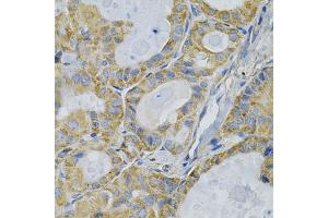 Immunohistochemistry of paraffin-embedded human thyroid cancer using TLR7 Antibody (ABIN1875113) at dilution of 1:100 (40x lens). (TLR7 antibody)