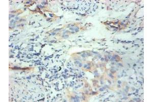 Immunohistochemical of paraffin-embedded human breast cancer tissue using ABIN7152614 at dilution of 1:200 (FABP3 antibody)