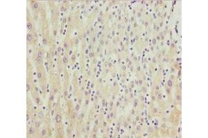 Immunohistochemistry of paraffin-embedded human liver cancer using ABIN7149264 at dilution of 1:100 (CYP3A4 antibody  (AA 244-503))