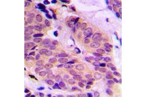 Immunohistochemical analysis of ABCD4 staining in human breast cancer formalin fixed paraffin embedded tissue section. (ABCD4 antibody  (Center))