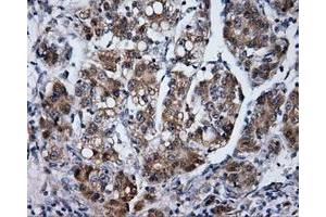 Immunohistochemical staining of paraffin-embedded Carcinoma of liver tissue using anti-LIPG mouse monoclonal antibody.