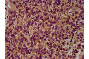 IHC image of ABIN7151037 diluted at 1:500 and staining in paraffin-embedded human glioma performed on a Leica BondTM system. (HECW2 antibody  (AA 495-641))
