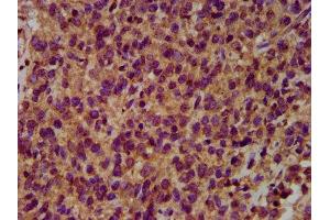 IHC image of ABIN7151037 diluted at 1:500 and staining in paraffin-embedded human glioma performed on a Leica BondTM system.