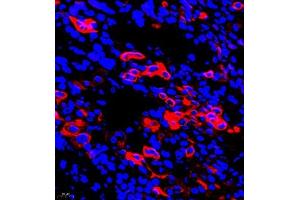 Immunofluorescent analysis of paraffin embedded human ovarian cancer using CK6 (ABIN7074423) at dilution of 1: 2000 (Keratin 6 antibody)