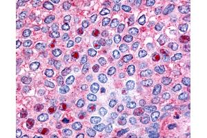 Anti-HNF4G / HNF4 Gamma antibody IHC of human Breast, Carcinoma. (HNF4 gamma antibody  (Ligand Binding Domain))