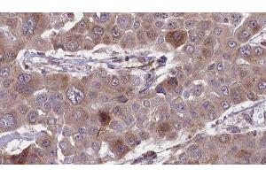 ABIN6276422 at 1/100 staining Human liver cancer tissue by IHC-P. (CEACAM5 antibody  (Internal Region))