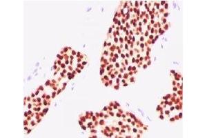 IHC testing of human breast carcinoma stained with Estrogen receptor antibody (NR3Ga-3). (Estrogen Receptor alpha antibody  (AA 2-185))