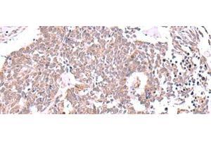 Immunohistochemistry of paraffin-embedded Human lung cancer tissue using JDP2 Polyclonal Antibody at dilution of 1:40(x200) (JDP2 antibody)